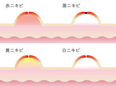 通常の毛穴